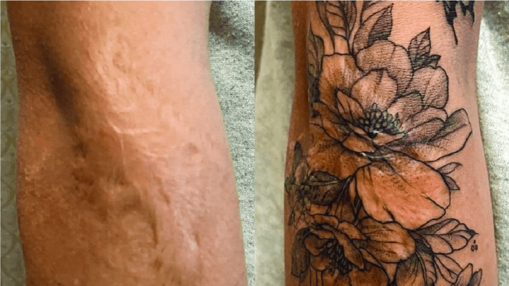 Can You have Tattoo Over Your Scars? 