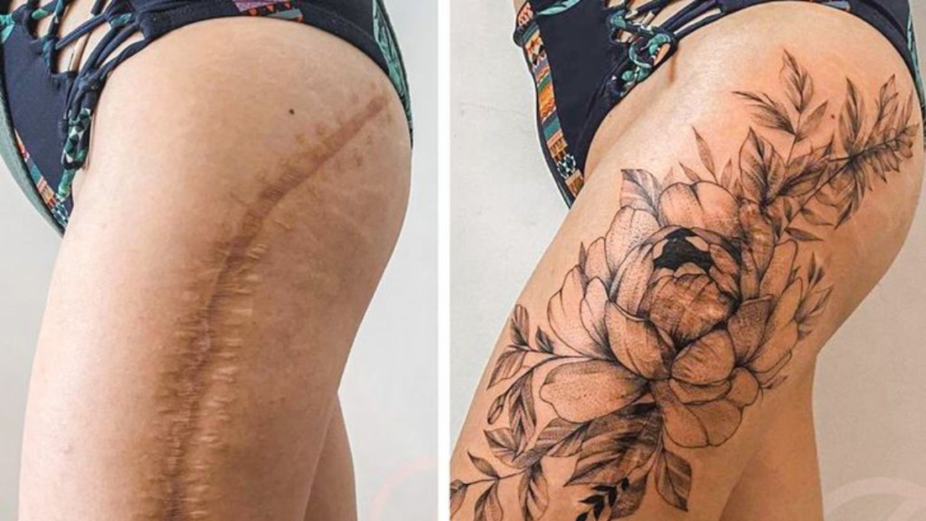 Can You have Tattoo Over Your Scars? 